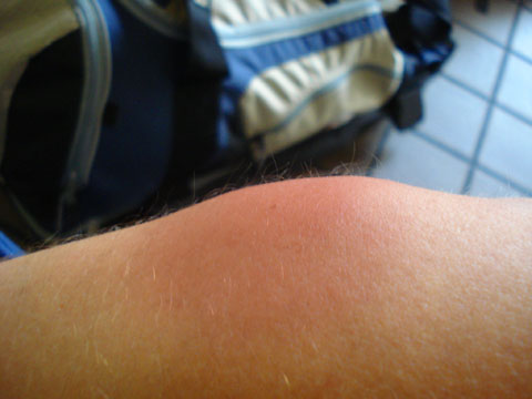 bedbug bite